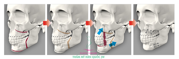 Bac si cho toi hoi ho ham la nhu the nao