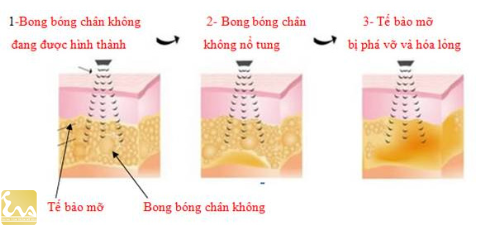 Cac phuong phap hut mo bung duoc ua chuong nhat