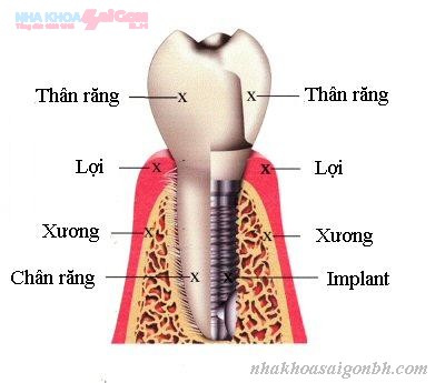 Cam ghep implant co thuc su tot khong