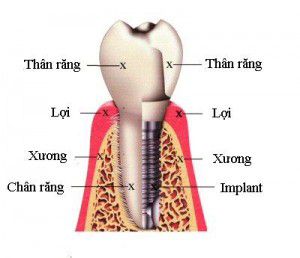 Cay ghep implant o dau an toan