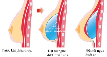 Nang nguc sao cho dep